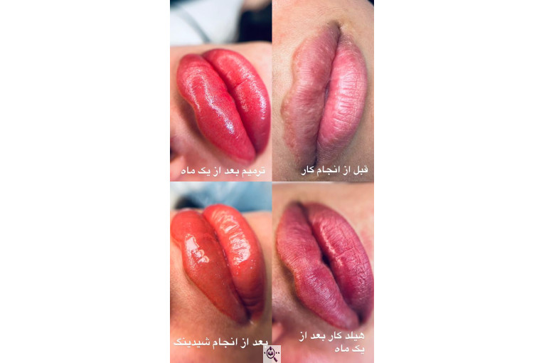 خدمات میکرو سمیرا نقی پور در معالی آباد شیراز