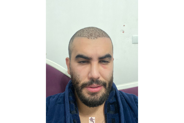 کاشت مو فرزانه رزمی در تهران