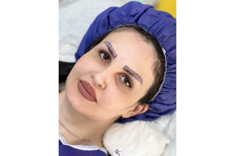 کاشت مو فرزانه رزمی در تهران