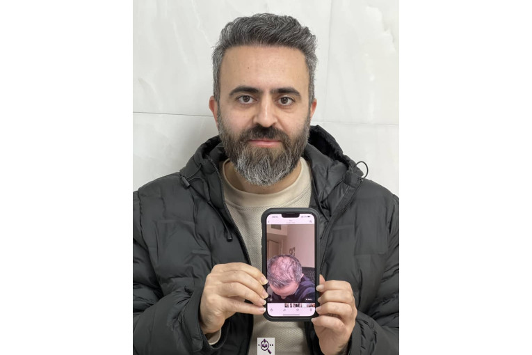 کاشت مو فرزانه رزمی در تهران