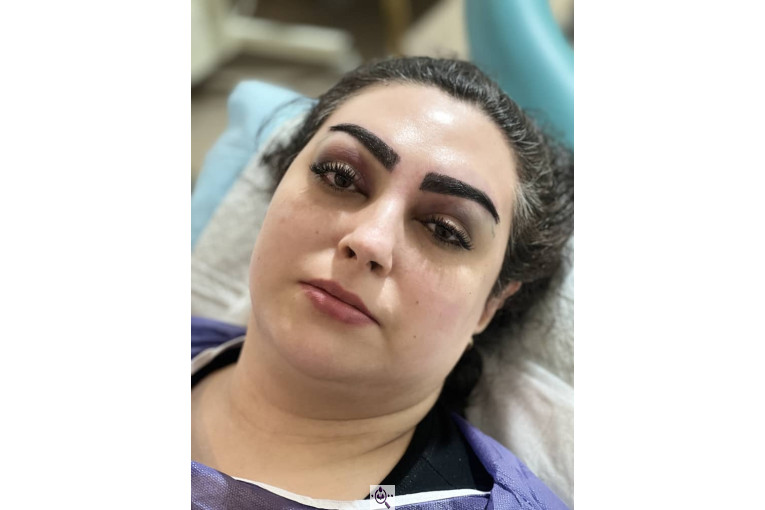 کاشت مو فرزانه رزمی در تهران