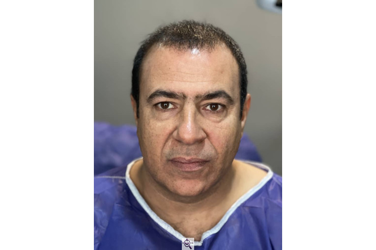 کاشت مو فرزانه رزمی در تهران