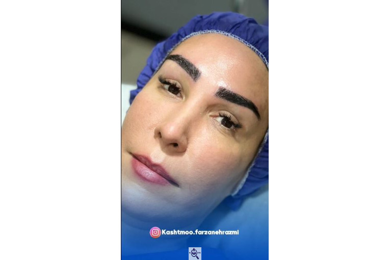 کاشت مو فرزانه رزمی در تهران