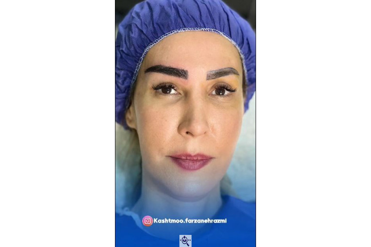 کاشت مو فرزانه رزمی در تهران