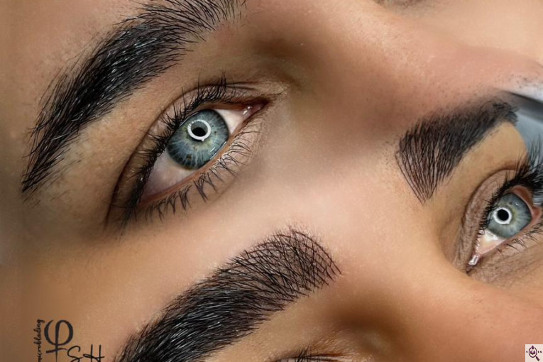 میکروبلیدینگ شاهدادی در کرمان