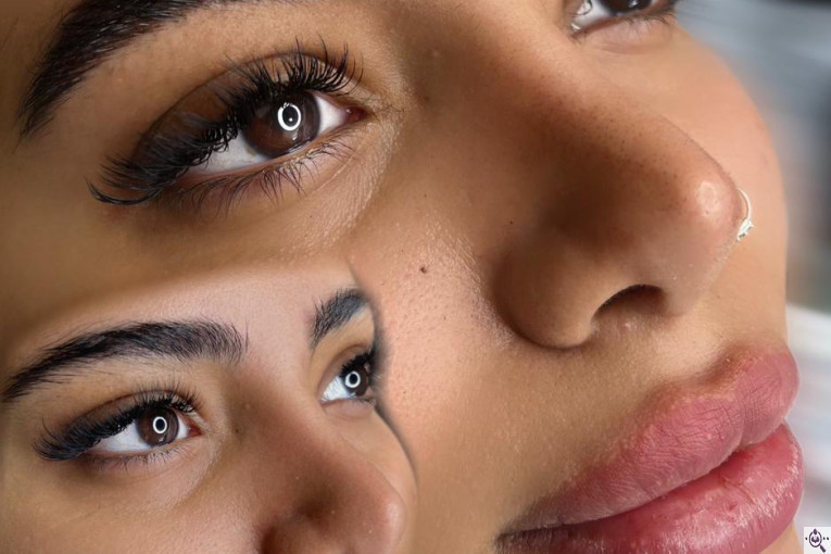 میکروبلیدینگ شاهدادی در کرمان