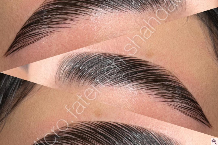 میکروبلیدینگ شاهدادی در کرمان