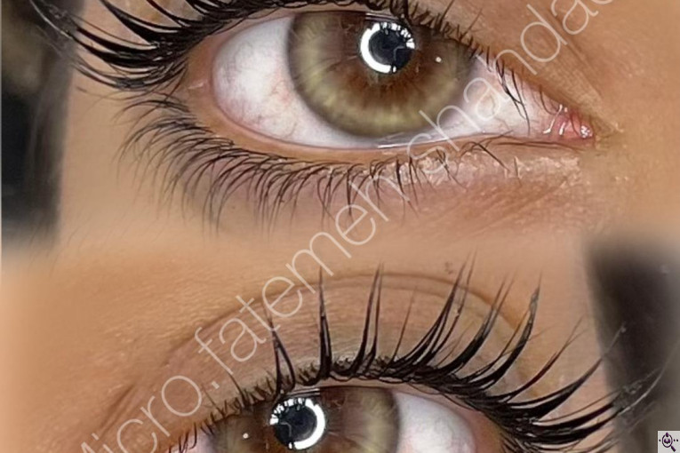 میکروبلیدینگ شاهدادی در کرمان