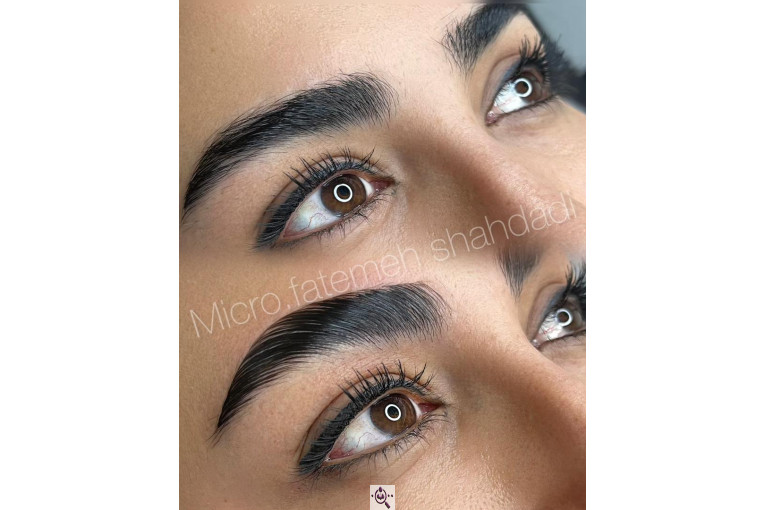 میکروبلیدینگ شاهدادی در کرمان