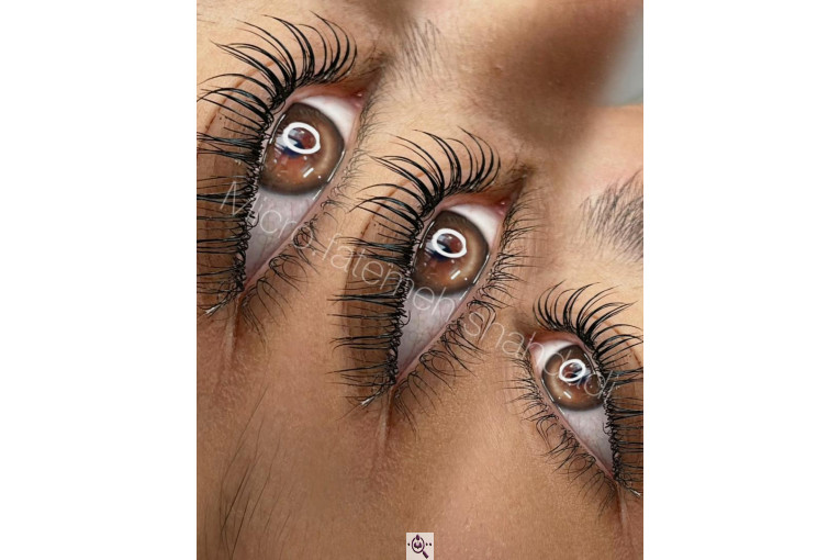 میکروبلیدینگ شاهدادی در کرمان