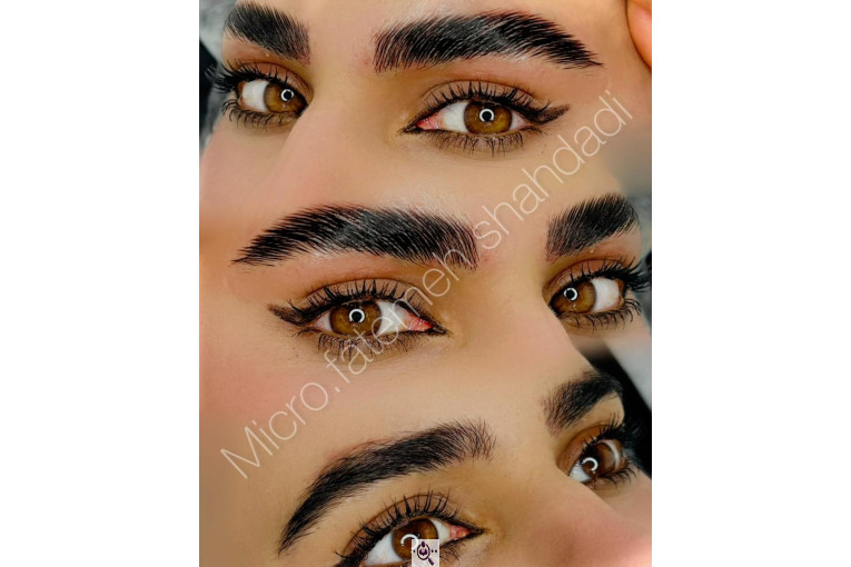 میکروبلیدینگ شاهدادی در کرمان