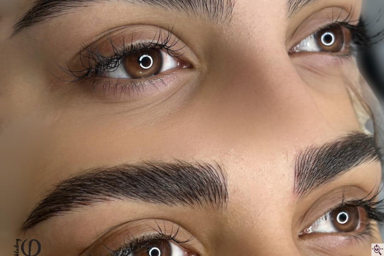 میکروبلیدینگ شاهدادی در کرمان