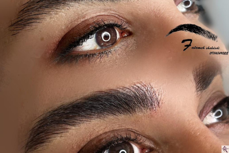 میکروبلیدینگ شاهدادی در کرمان