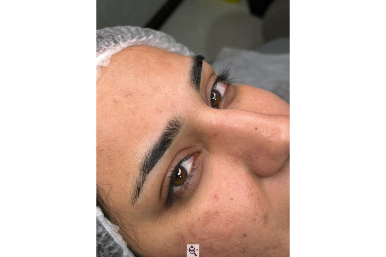 میکروبلیدینگ لیدا ابوالفضلی در یزد