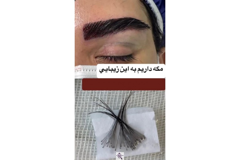 کاشت ابرو سمیرا سلطانی در مشهد