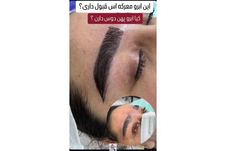 کاشت ابرو سمیرا سلطانی در مشهد