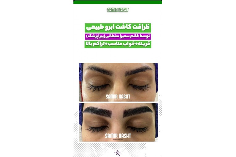 کاشت ابرو سمیرا سلطانی در مشهد