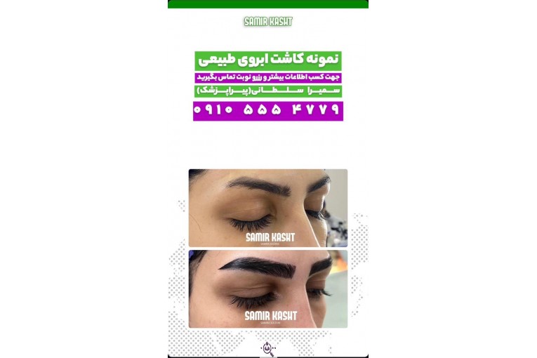 کاشت ابرو سمیرا سلطانی در مشهد