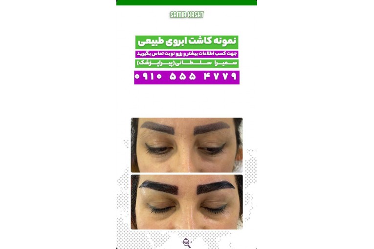 کاشت ابرو سمیرا سلطانی در مشهد
