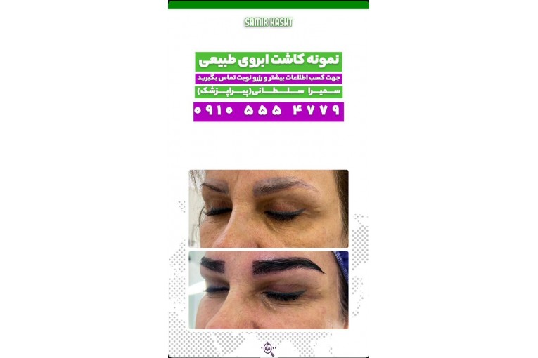 کاشت ابرو سمیرا سلطانی در مشهد