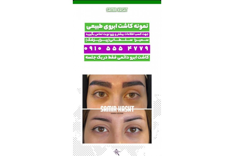 کاشت ابرو سمیرا سلطانی در مشهد