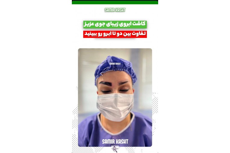 کاشت ابرو سمیرا سلطانی در مشهد