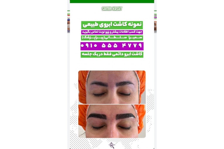 کاشت ابرو سمیرا سلطانی در مشهد