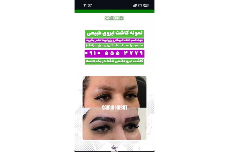 کاشت ابرو سمیرا سلطانی در مشهد