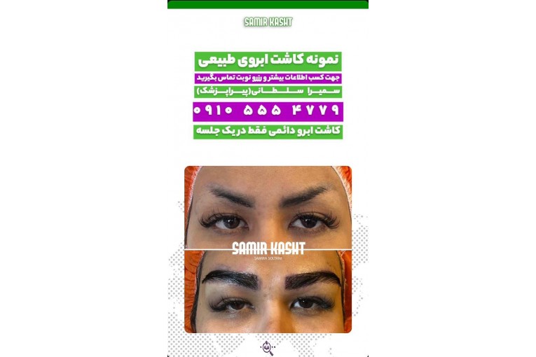 کاشت ابرو سمیرا سلطانی در مشهد