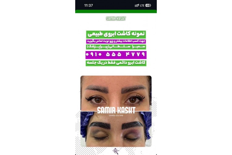 کاشت ابرو سمیرا سلطانی در مشهد
