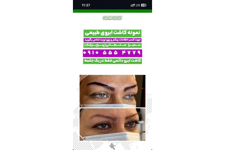 کاشت ابرو سمیرا سلطانی در مشهد