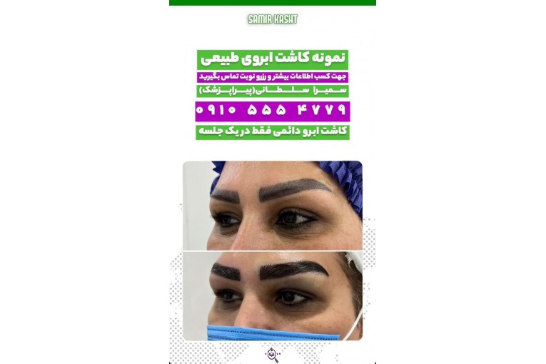 کاشت ابرو سمیرا سلطانی در مشهد