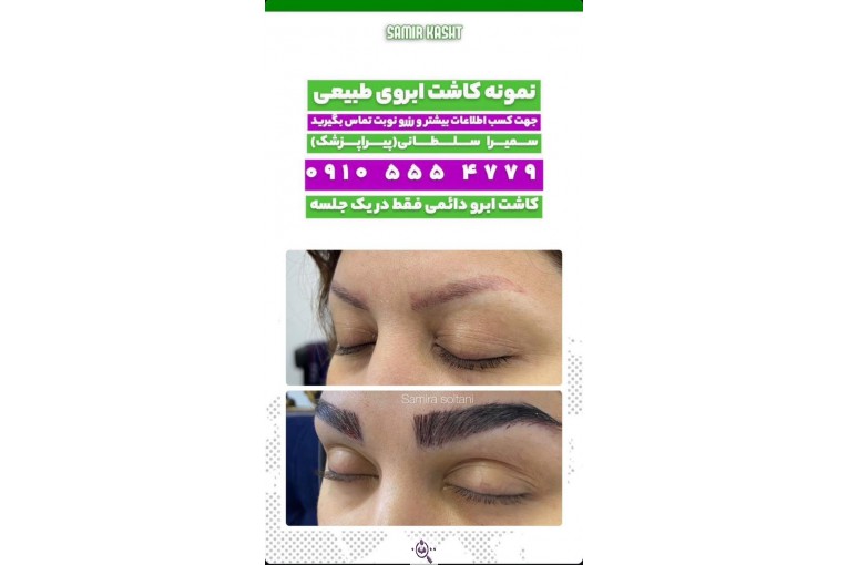 کاشت ابرو سمیرا سلطانی در مشهد