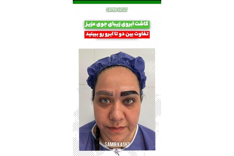 کاشت ابرو سمیرا سلطانی در مشهد