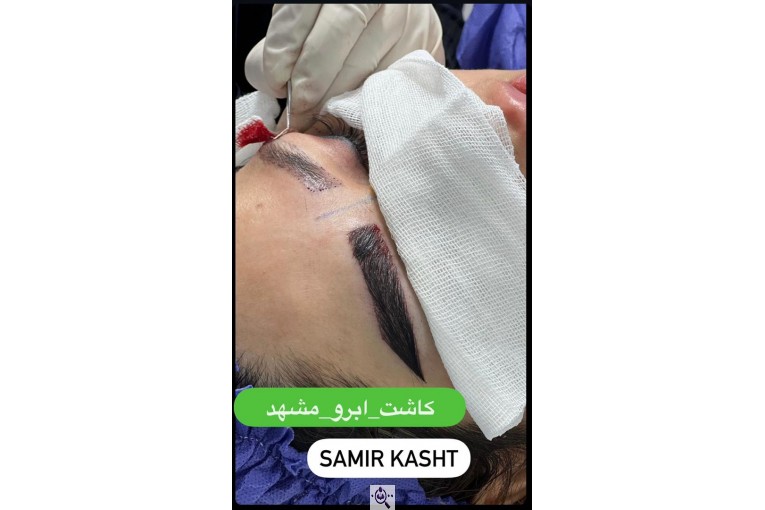 کاشت ابرو سمیرا سلطانی در مشهد