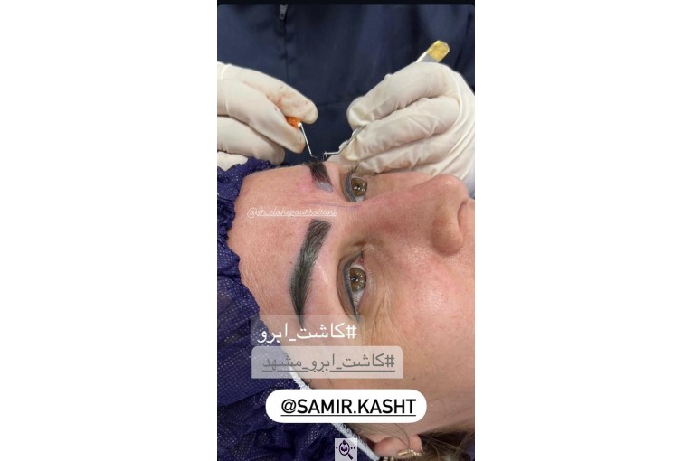 کاشت ابرو سمیرا سلطانی در مشهد