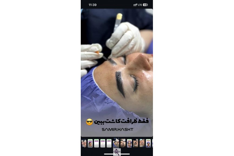 کاشت ابرو سمیرا سلطانی در مشهد