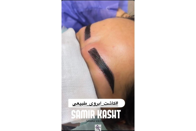 کاشت ابرو سمیرا سلطانی در مشهد