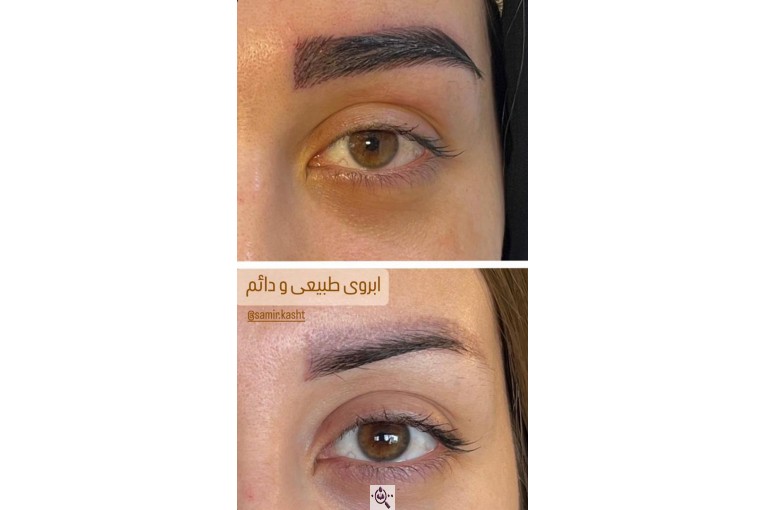 کاشت ابرو سمیرا سلطانی در مشهد