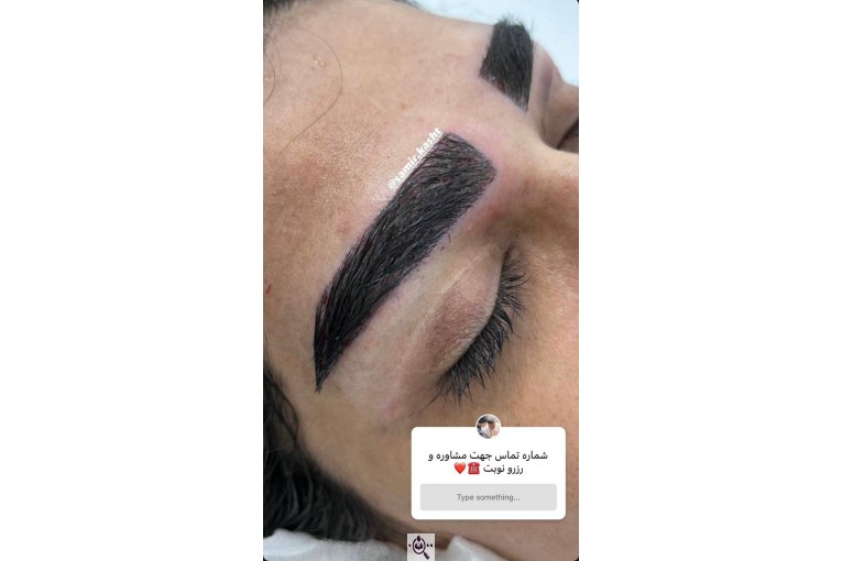 کاشت ابرو سمیرا سلطانی در مشهد