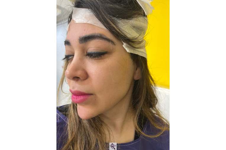 کاشت مو زینب خواجه پور در اهواز