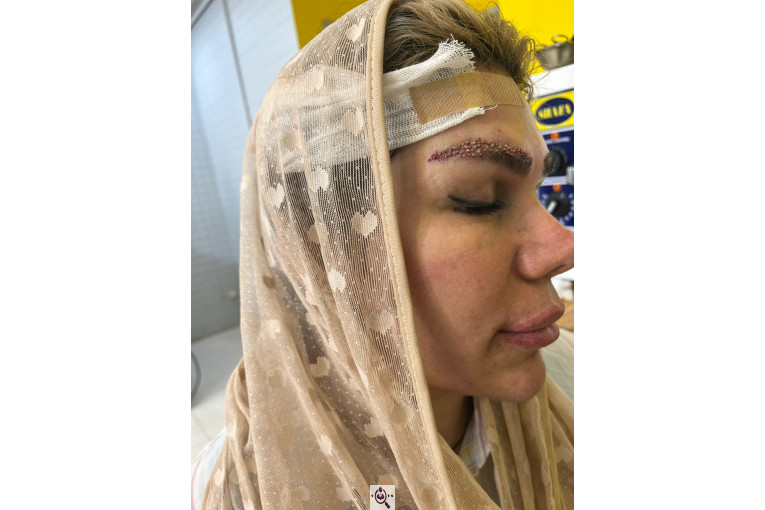 کاشت مو زینب خواجه پور در اهواز