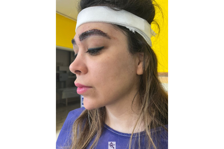 کاشت مو زینب خواجه پور در اهواز