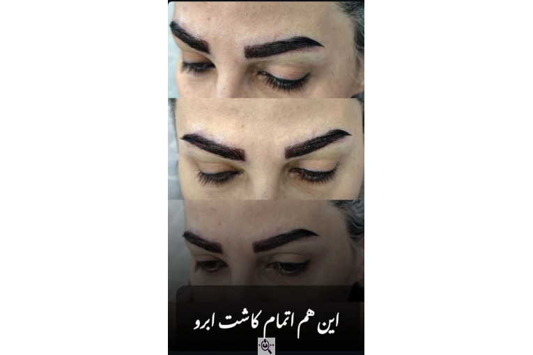 کاشت مو زینب خواجه پور در اهواز