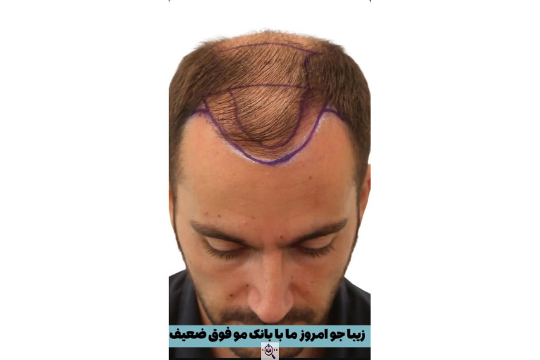 کاشت مو زینب خواجه پور در اهواز