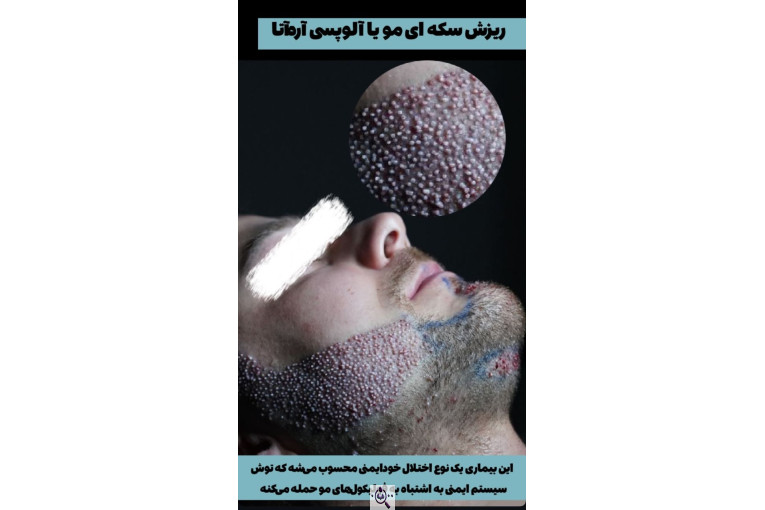 کاشت مو زینب خواجه پور در اهواز