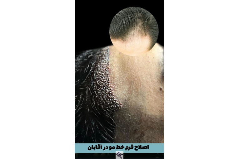 کاشت مو زینب خواجه پور در اهواز