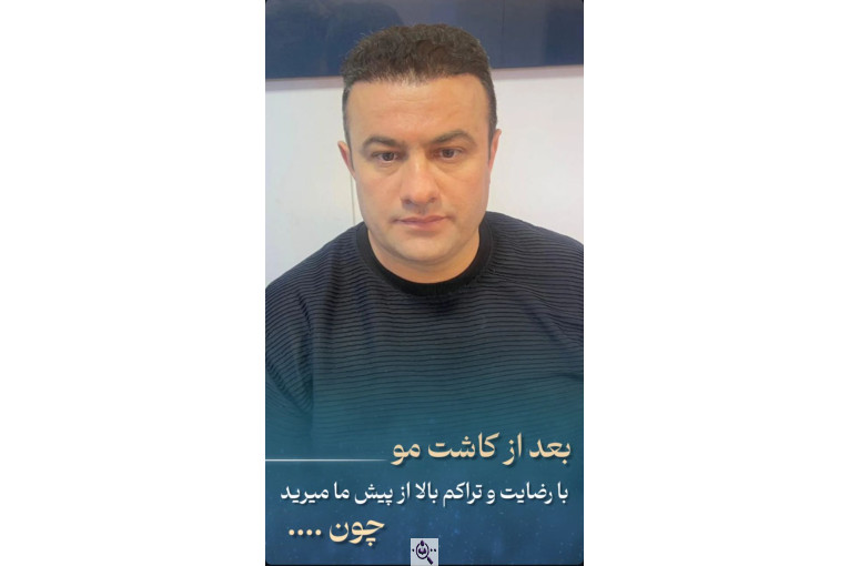 کاشت مو زینب خواجه پور در اهواز