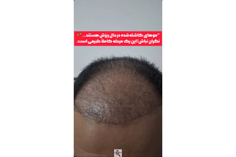 کاشت مو زینب خواجه پور در اهواز