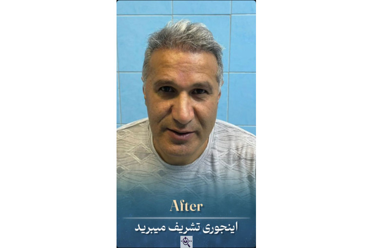 کاشت مو زینب خواجه پور در اهواز